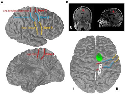 Variables associated with cortical motor mapping thresholds: A retrospective data review with a unique case of interlimb motor facilitation